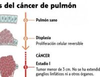 En Colombia, más de 5 mil personas padecen cáncer de pulmón