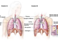 Cáncer de Pulmón, responsable del 70 por ciento de las muertes por cáncer en el mundo