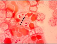 Lo que usted debe saber sobre la meningitis meningocócica