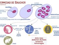 Enfermedad de Gaucher: una patología rara que deteriora notablemente la calidad de vida